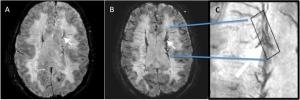 An MRI image of the brain before (A) and after (B) novel MRI dye infused. Magnified image (C) after the MRI dye is infused demonstrates accumul