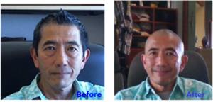 Dr. Bruce Shiramizu, before and after his head-shaving for charity. 